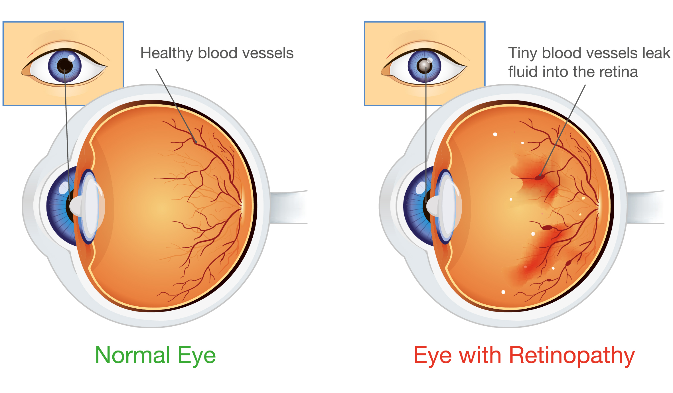 Diagram comparing a normal, healthy eye to an eye with diabetic retinopathy, showing leaking blood vessels damaging the retina